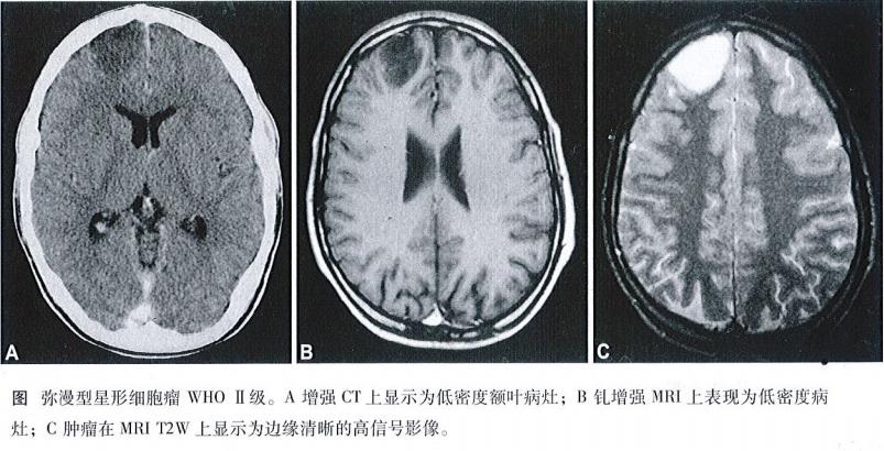 蝶鞍占位性病變病因全解析：從垂體瘤到血管病變